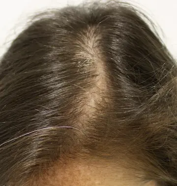 champú de aloe vera ayuda alopecia femenina