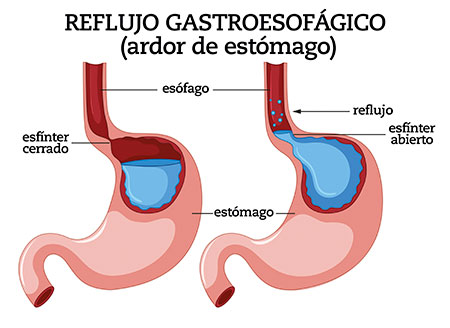 pastillas de aloe vera para el reflujo